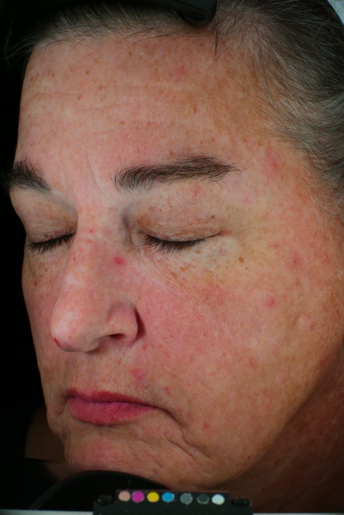 Collagen Microneedling Before and After | Collagen P.I.N.®