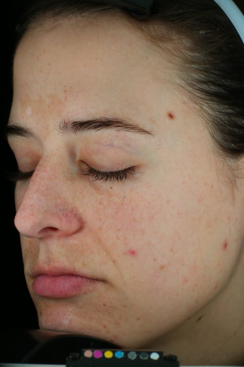 Collagen Microneedling Before and After | Collagen P.I.N.®