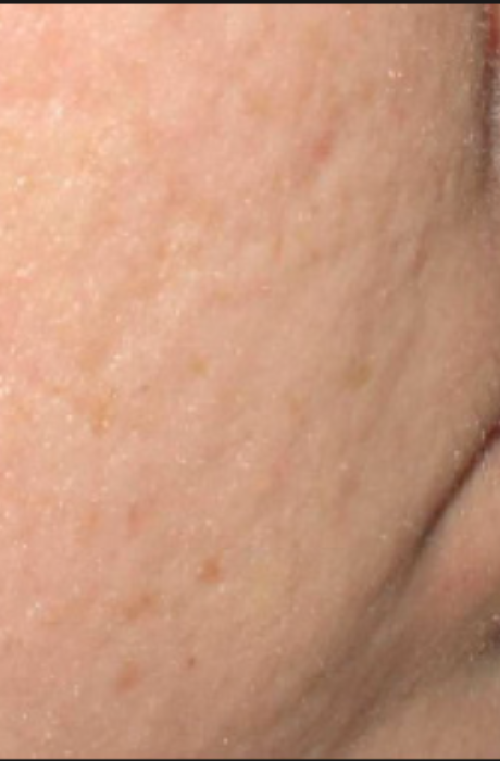 Acne Scar Results AFTER