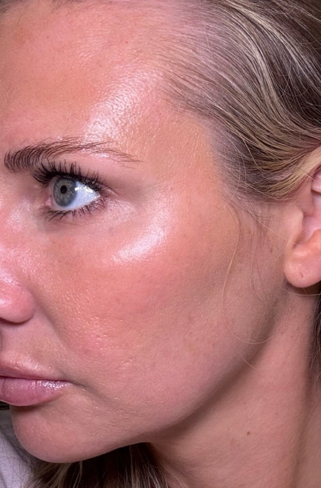 Collagen-PIN-Results-Skin-Rejuvenation-2