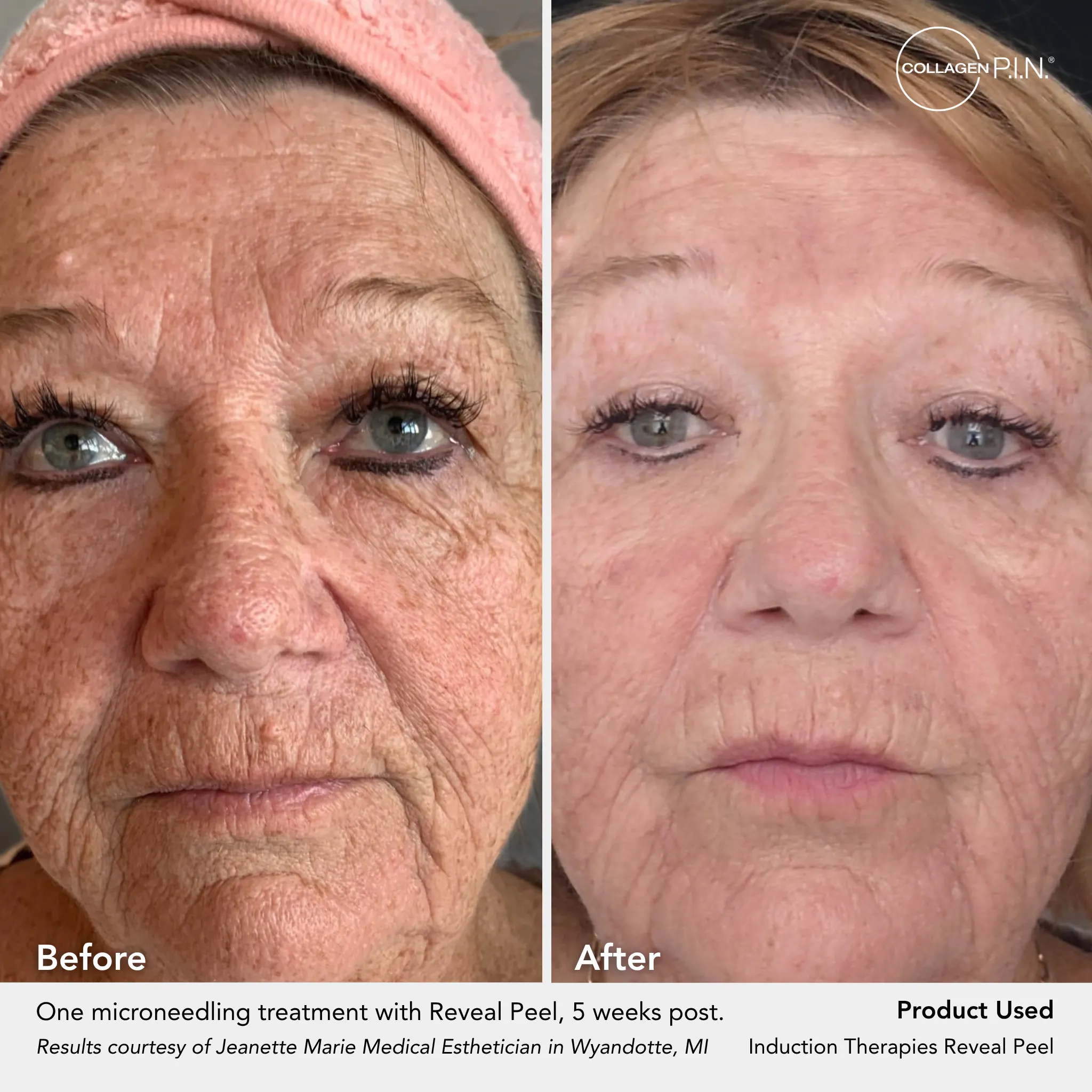 Before and after: microneedling and Reveal Peel result submitted by Jeanette Nemeth, 5 weeks post-treatment