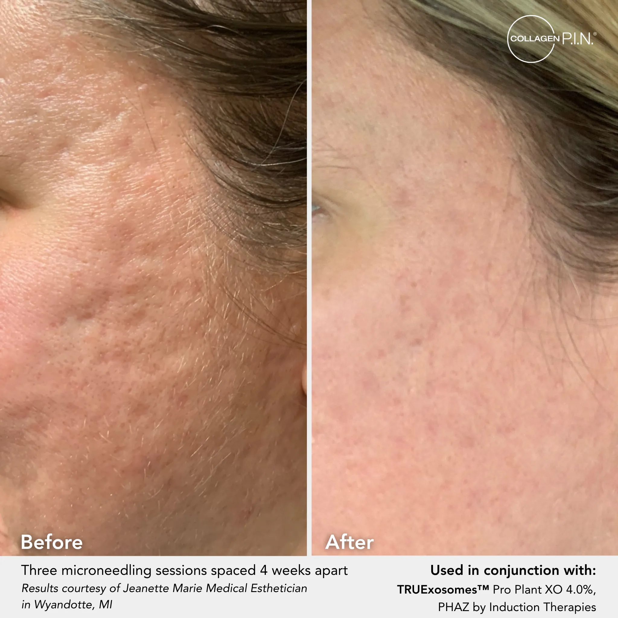 Before and after: microneedling for acne scar appearance, submitted by Jeanette Nemeth