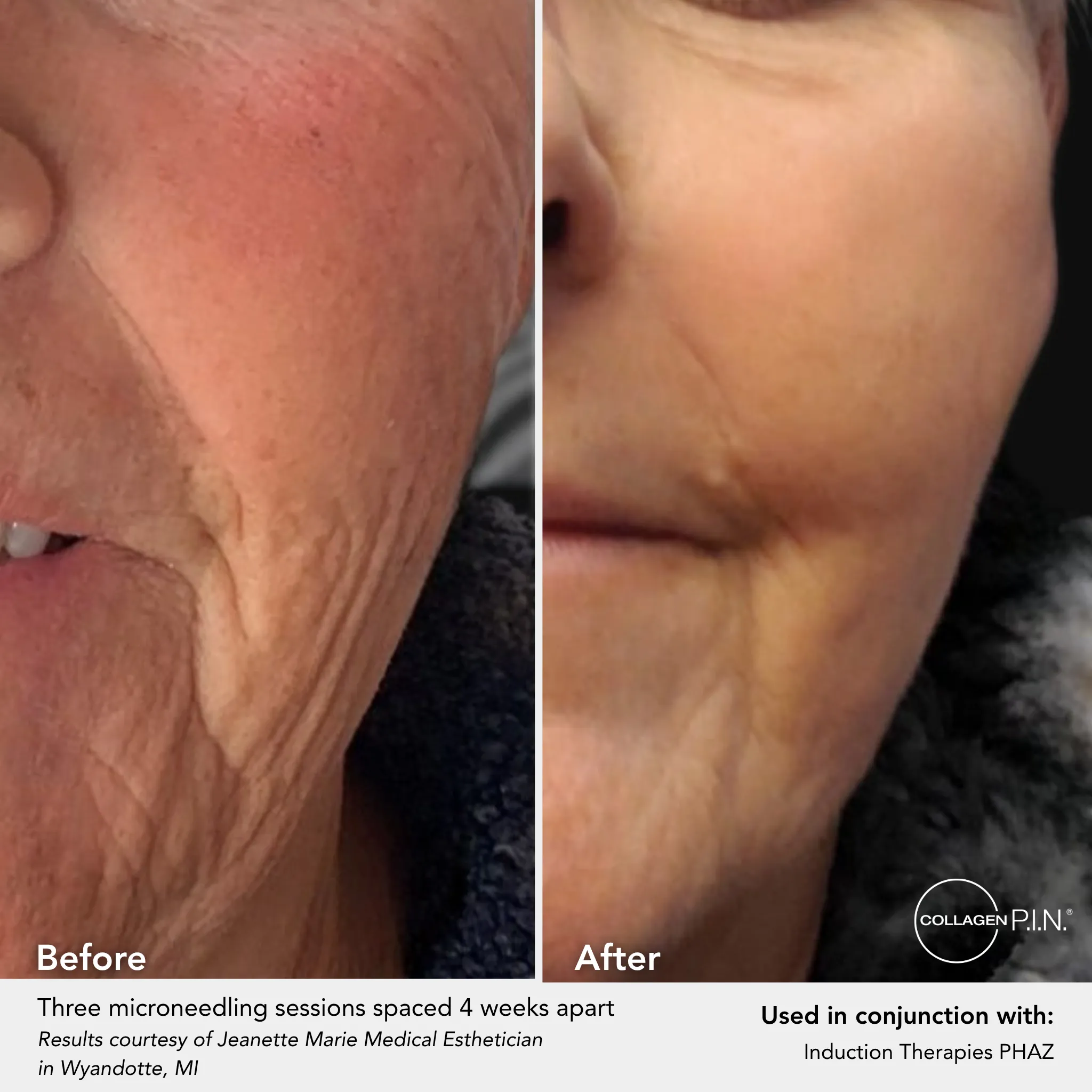 Before and after: wrinkle reduction across three microneedling sessions, submitted by Jeanette Nemeth