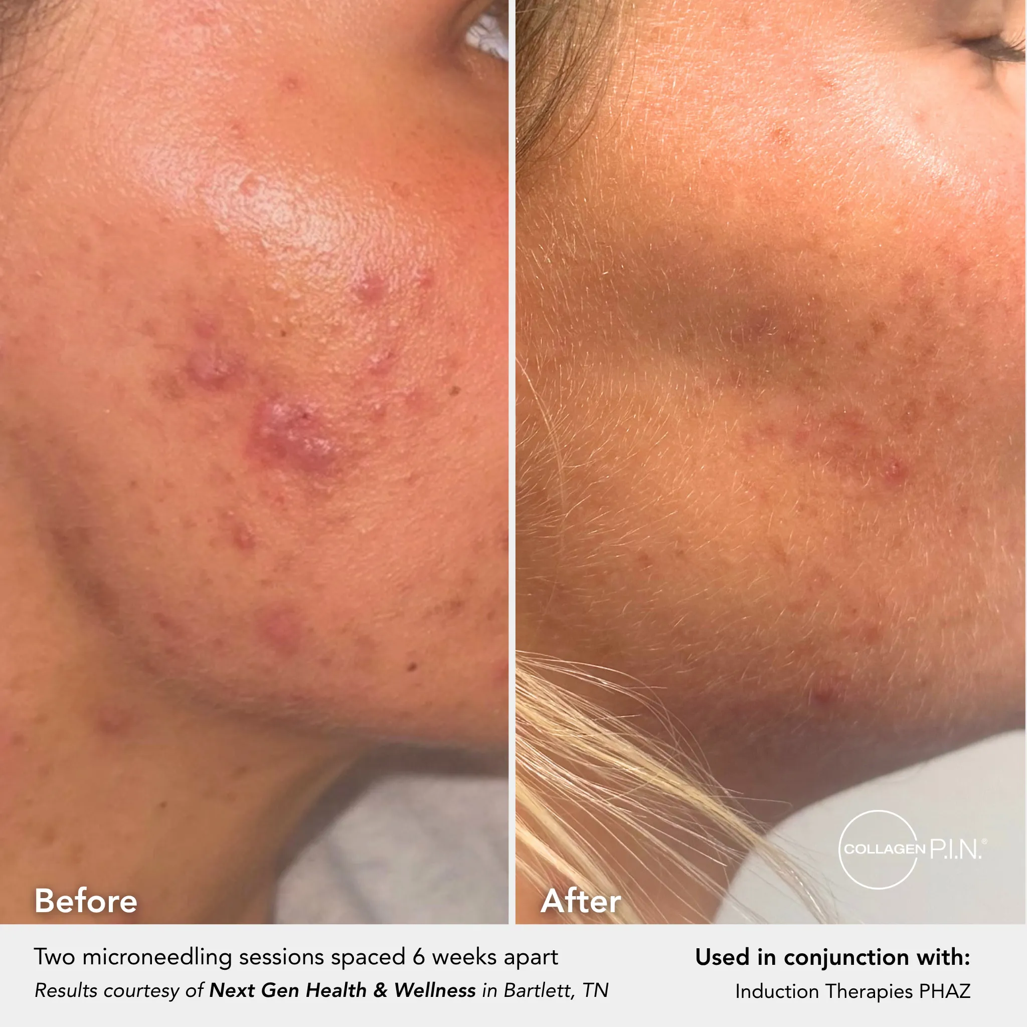 Before and after: blemish reduction from microneedling with PHAZ, submitted by Next Gen Health & Wellness